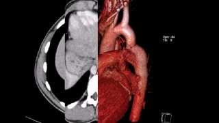 КТ грудной клетки коарктация аорты [upl. by Adnaral852]