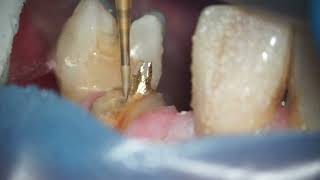 Dentatus Screw Post Removal [upl. by Hadwin]