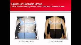 SpineCor Scoliosis Brace Patient Case Study [upl. by Nils]