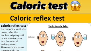 Caloric test explained by practically [upl. by Sessilu]