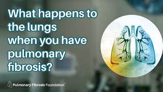 How Pulmonary Fibrosis Affects the Lungs [upl. by Nnahgiel170]