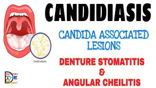 CANDIDIASIS  CANDIDA ASSOCIATED LESIONS  DENTURE STOMATITIS amp ANGULAR CHEILITIS [upl. by Ase]