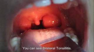 Examination Of Tonsils [upl. by Suvart940]