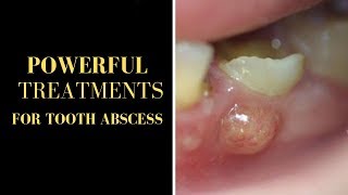 Tooth Abscess Treatment GOLDEN TECHNIQUE TO CURE TOOTH ABSCESS NATURALLY IN RECORD TIME [upl. by Aelgna]