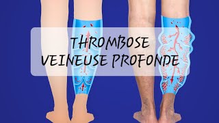 TVP  thrombose veineuse profonde [upl. by Duomham]