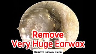 Remove Super Huge Earwax and Clean Ears  EP 024 [upl. by Venu]