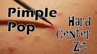 Pimple Pop  Hard Center Zit High Definition 1080p [upl. by Tibbetts]