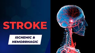 Ischemic and Hemorrhagic Strokes Signs Symptoms and Treatment [upl. by Bodi]