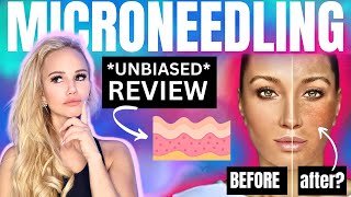 Is microneedling worth it [upl. by Eirrok]