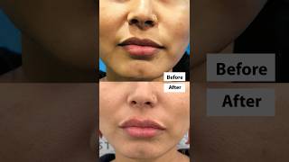 💋Improved Lip Shape by Fillers  Live Procedure shortfeeds lipfiller [upl. by Adnohser]