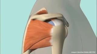 Chronic Subacromial Impingement Animation [upl. by Gwenn]