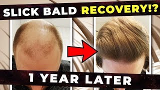 Do Hair Follicles Permanently Die After You Go Bald Can They Be Recovered [upl. by Gnauq]