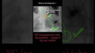 NG nasogastrictube tip position Image 2 tip visible 182 chest Xray tubes radiologychannel007 [upl. by Elke662]