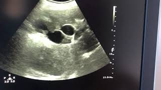 Dilated intrahepatic biliary radicles lab report is uploades in other video [upl. by Sufur]