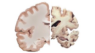 Alzheimers and the Brain [upl. by Ennahgem]