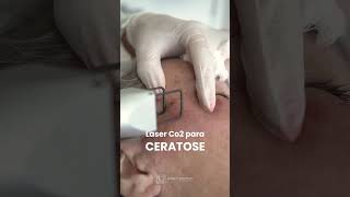 Com tratar ceratose com laser CO2 fracionado Dra Bianca Gastaldi  Dermatologista Joinville [upl. by Alek]