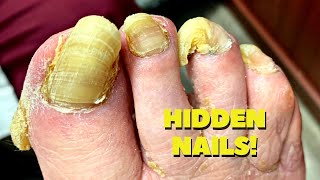 THICK Diabetic Nails And Callus Trimming [upl. by Sylado]