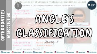 Angles Classification of Malocclusion  Dr Paridhi Agrawal [upl. by Guttery485]