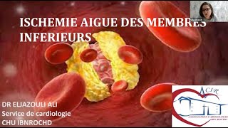 Ischémie aiguë des membres inferieurs  Service de cardiologie CHU Ibn Rochd ACIR [upl. by Sherrill]