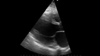 parasternal long axis echo of a patient with dilated cardiomyopathy [upl. by Enitsenre]