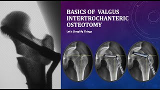 Basics of Valgus Intertrochanteric Osteotomy for Hip Fractures Simplified [upl. by Moia76]