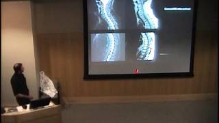 Tumor Necrosis Factor Alpha Antagonists and CNS Demyelination [upl. by Dewie405]