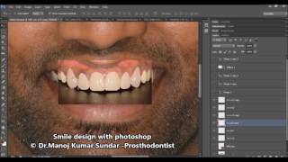 Smile design with Photoshop by DrManoj Kumar Sundar [upl. by Dnaltruoc]