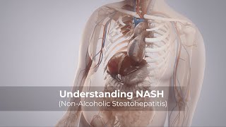 Understanding NASH NonAlcoholic Steatohepatitis [upl. by Ahsikat]