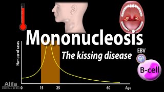 Infectious Mononucleosis Mono  the Kissing Disease Animation [upl. by Ahseeyt]