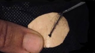 Removal of ingrown Hair Mirada [upl. by Aillicec]