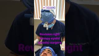 Revision on Droopy Right Eyelid Ptosis Surgery [upl. by Carhart]