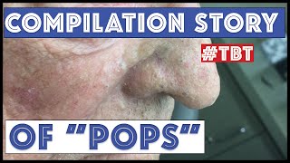 quotPopsquot and his BEST blackhead extractions  TBT [upl. by Foulk364]