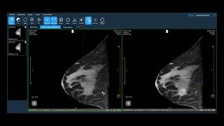 Koning Clinical Case Review Invasive Lobular Carcinoma [upl. by Eeryn624]