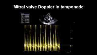 Echocardiography Essentials Detecting pericardial effusions [upl. by Alahsal]