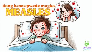 Ilang beses pwede magka MEASLES Tigdas  AskDocGan [upl. by Micheil111]