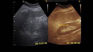 Ultrasound cases 361 of 2000  Utricle Cyst Splenic Cyst Hypoechoic nodule Breast Duct ectasia [upl. by Styles]