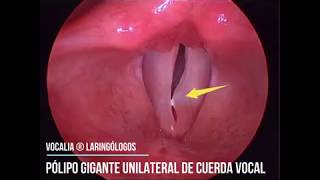 PÓLIPO GIGANTE DE CUERDAS VOCALES  GYANT VOCAL FOLD POLYP [upl. by Enneillij]