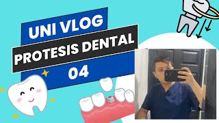 UNI VLOG Prótesis dental enmuflado puente veneer combinado puente Maryland corona jacket [upl. by Doralynne800]