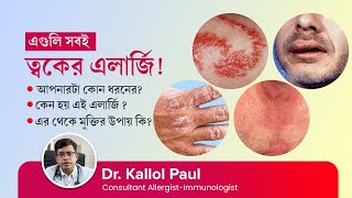 এলার্জি কত প্রকার এর থেকে মুক্তির উপায় কি  Types of allergy in skin amp How to cure allergy in skin [upl. by Hanway]