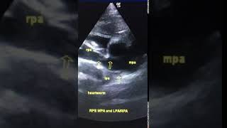 Ultrasound heartworm in the right pulmonary artery of a dog [upl. by Egres211]