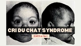 Cri Du Chat Syndrome CdCS or 5p  Genetics  Medicine [upl. by Enirahtac]