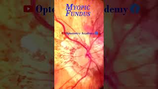 Myopic degeneration  Smartphone Fundus Videography  Fundus Photography  Short Video 63 [upl. by Whetstone]