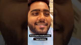 Braces smile transformation by DrKirubaharan MDS opal dentistry Chennai [upl. by Nailliw]