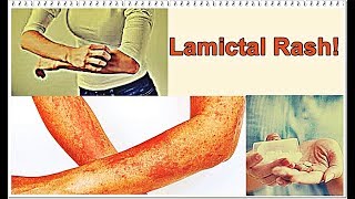 Lamictal Rash – Symptoms Treatment [upl. by Natsirt]