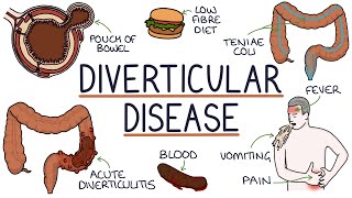 Understanding Diverticulosis and Diverticulitis [upl. by Onaicnop]