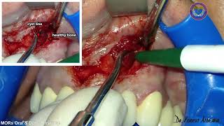 Dr Korkut Aldemir  Maxillary Odontogenic Radicular Cyst [upl. by O'Shee]