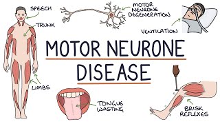 Understanding Motor Neurone Disease Amyotrophic Lateral Sclerosis [upl. by Albertina308]