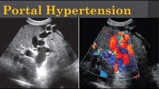 Portal Hypertension [upl. by Stirling]