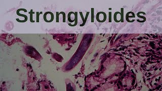 Strongyloides and Strongyloidiasis  Pathology mini tutorials [upl. by Siblee]