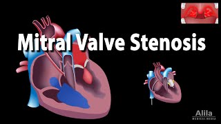 Mitral Valve Stenosis Animation [upl. by Mor86]